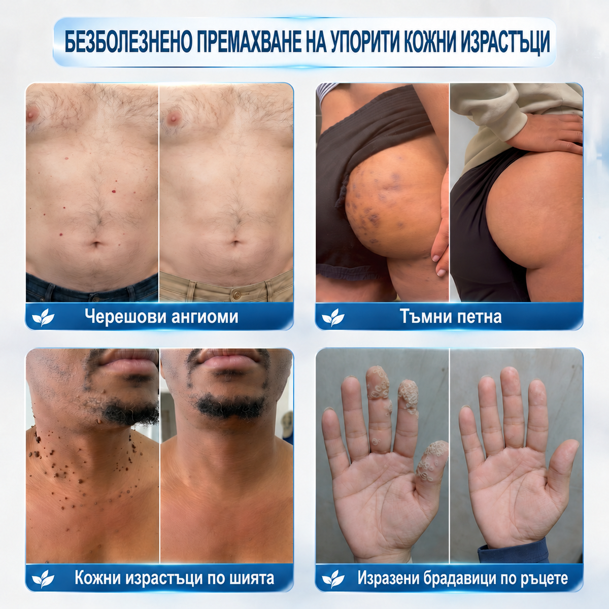 ⭐🐒 Официален магазин | 𝐕𝐄𝐋𝐍𝐎𝐑𝐀® Билков хидроколоиден пластир с микроигли (за кожни образувания, малки кожни израстъци, брадавици, бенки, старчески петна и пигментни петна)
